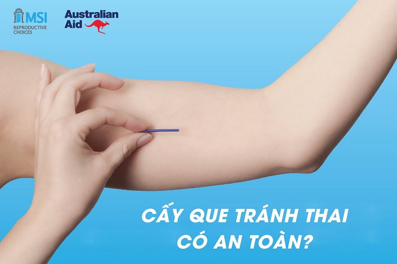 cấy que tránh thai